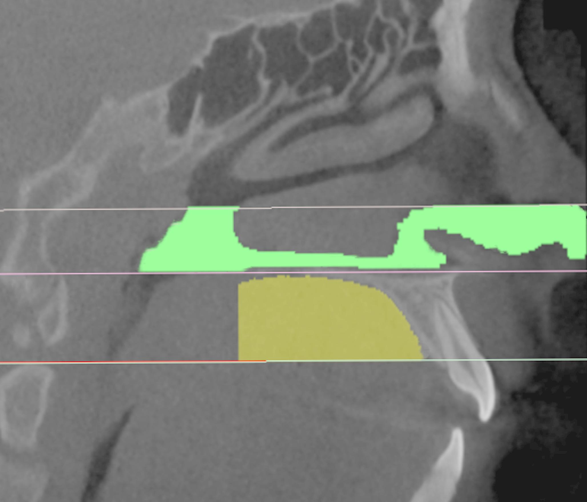 Comparison of nasal passage and palatal volume in obstructive sleep apnea patients and healthy individuals using cone beam computed tomography