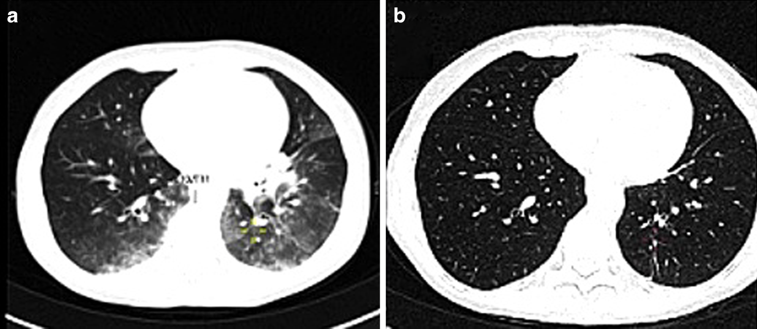 Hemophagocytic lymphohistiocytosis induced by radio-chemo-immunotherapy: a case report