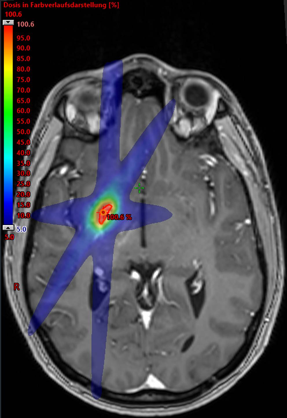Stereotactic radiosurgery for cerebral arteriovenous malformations