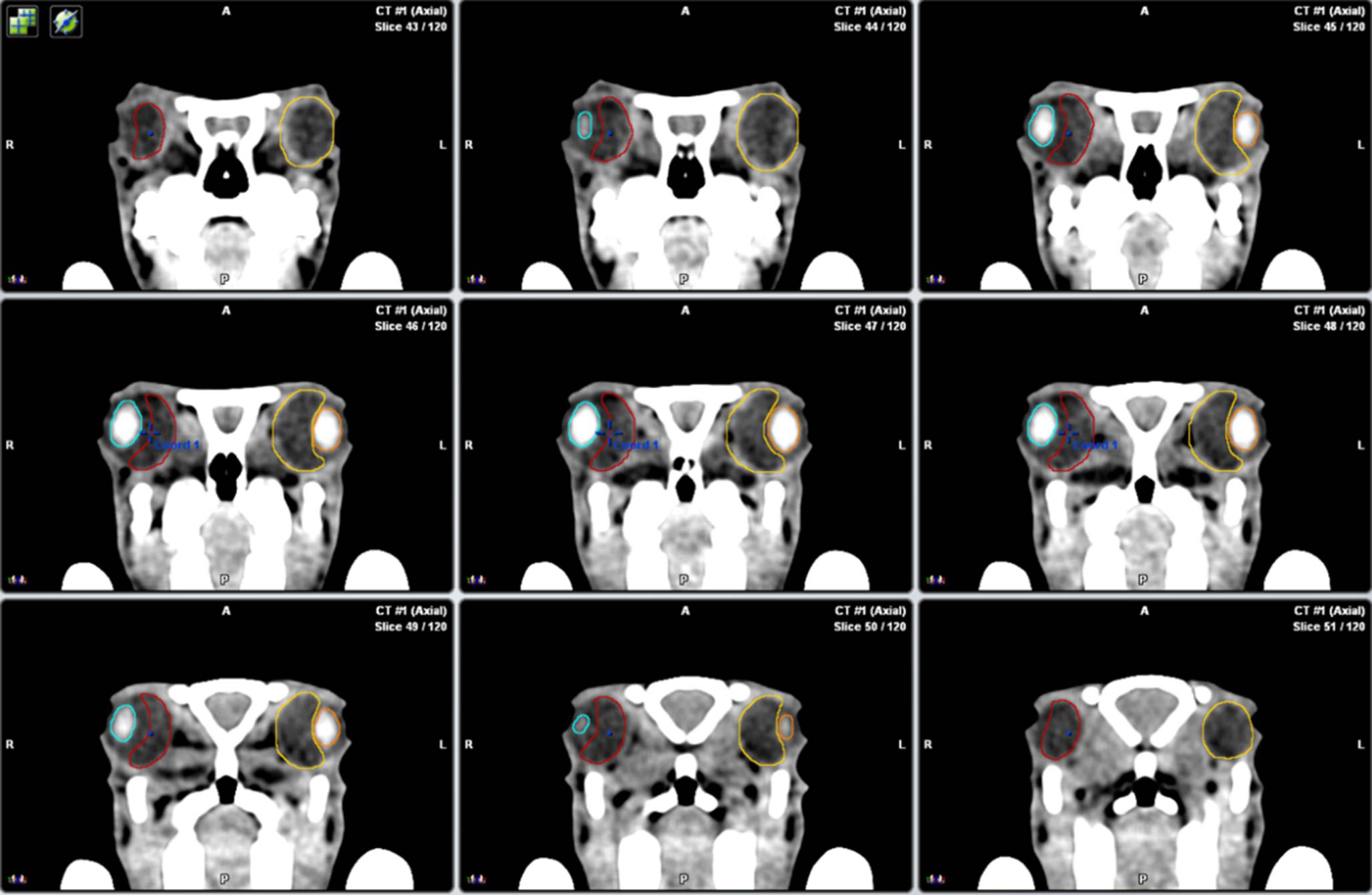 The impact of vitreous humor: a new perspective on radiation-induced cataractogenesis