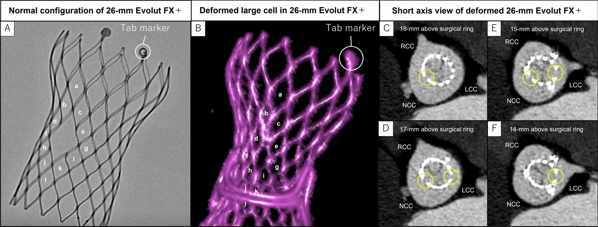 Large stent frame deformation in a self-expandable transcatheter heart valve after valve-in-valve implantation for failed surgical valve