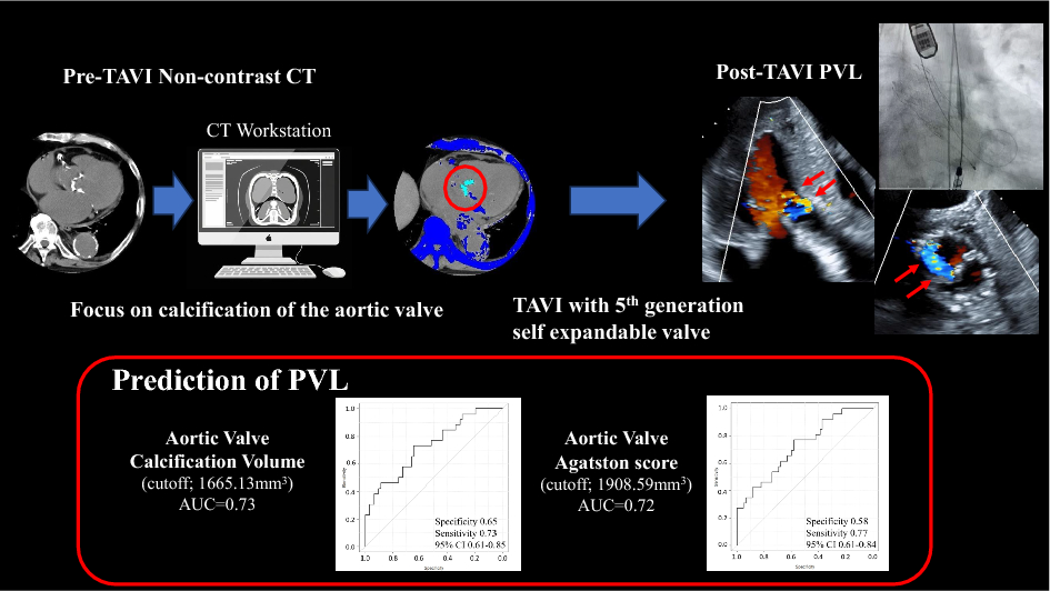 Analysis of predictors of paravalvular leakage after transcatheter aortic valve implantation with fifth-generation self-expandable valve