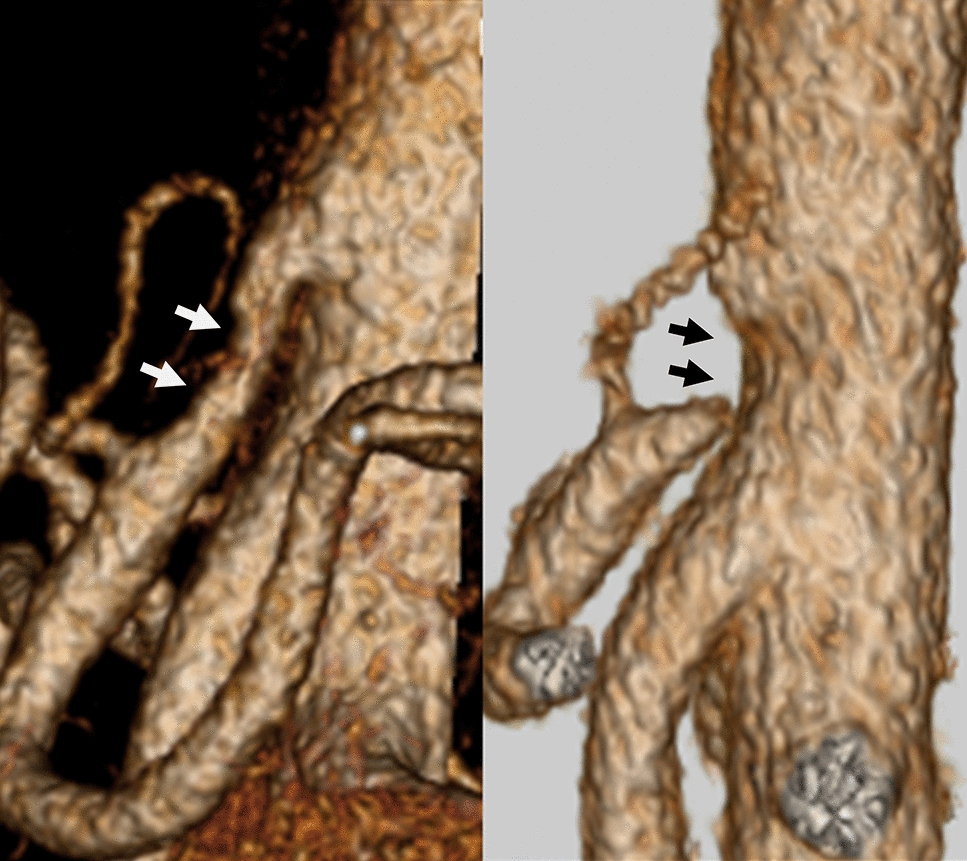 Laparoscopic surgery for median arcuate ligament syndrome: How to do it
