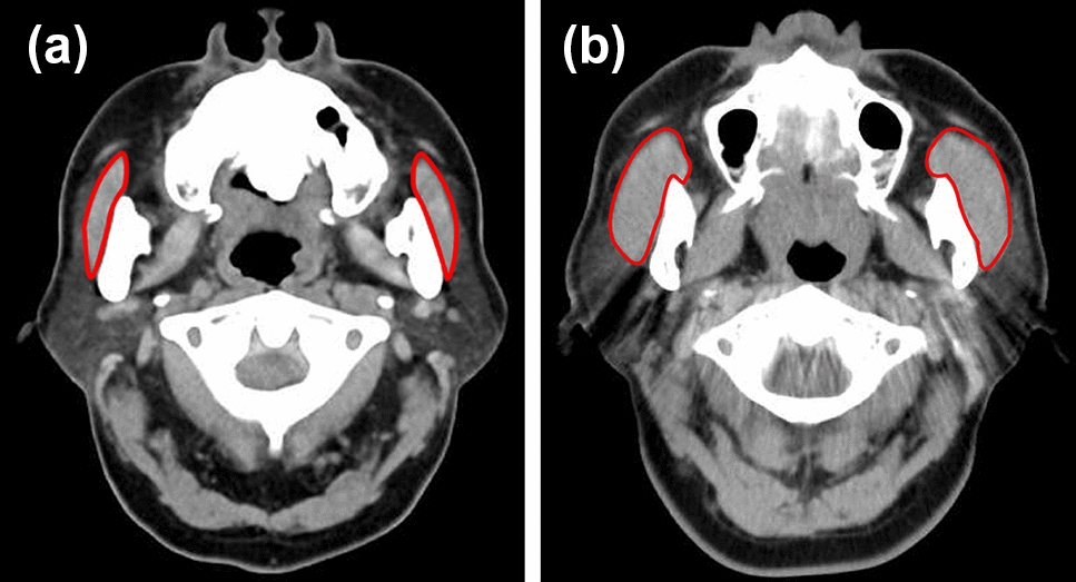 The impact of oral frailty on chronic limb-threatening ischemia: the masseter muscle area as a predictive marker for pneumonia and survival