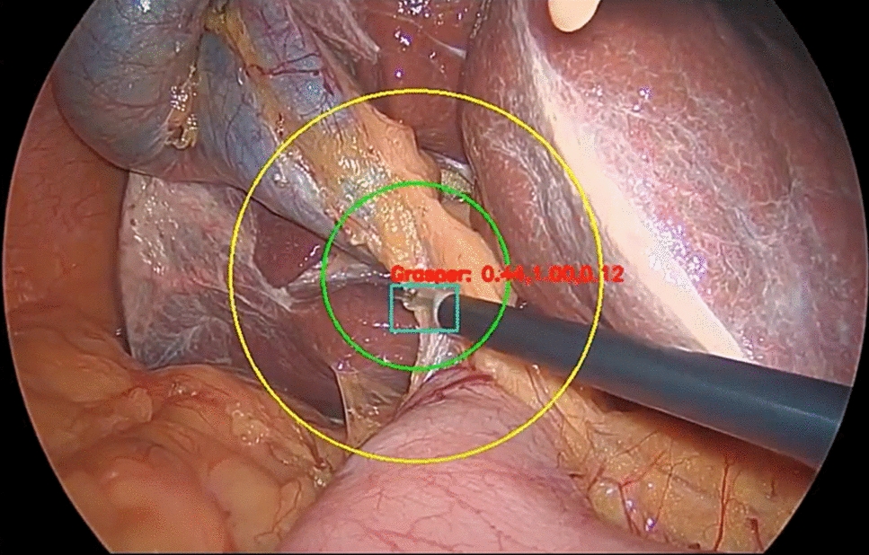 Safety and feasibility of solo surgery using a novel robotic platform: an IDEAL 2a development study
