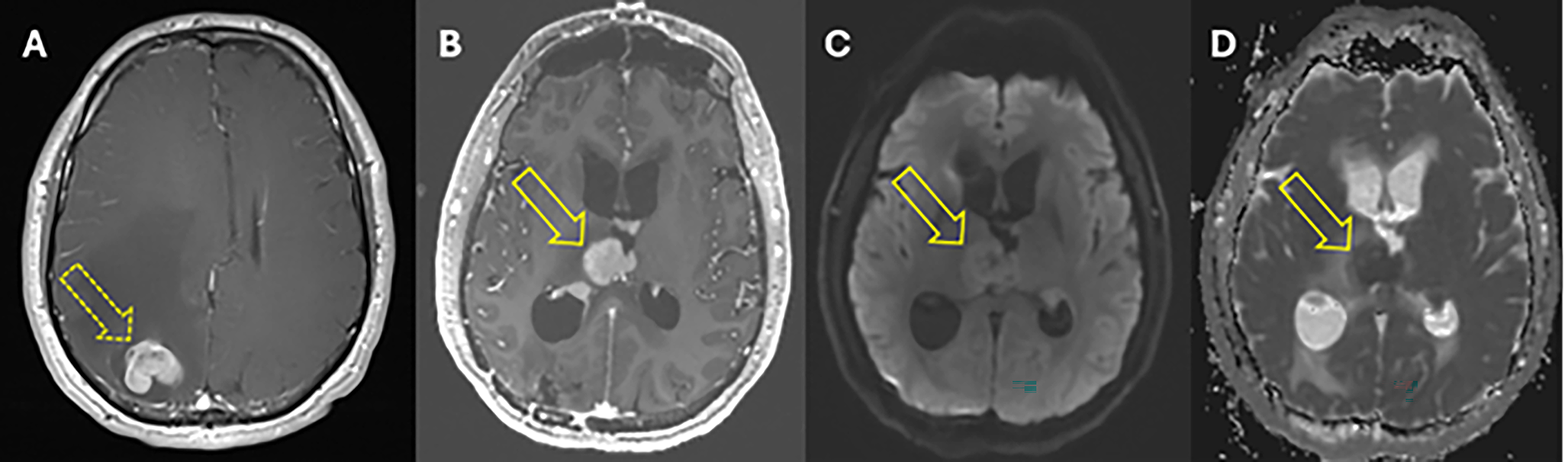 Clinical utility of repeat brain biopsy in recurrent or refractory primary CNS lymphoma – a diagnostic dilemma