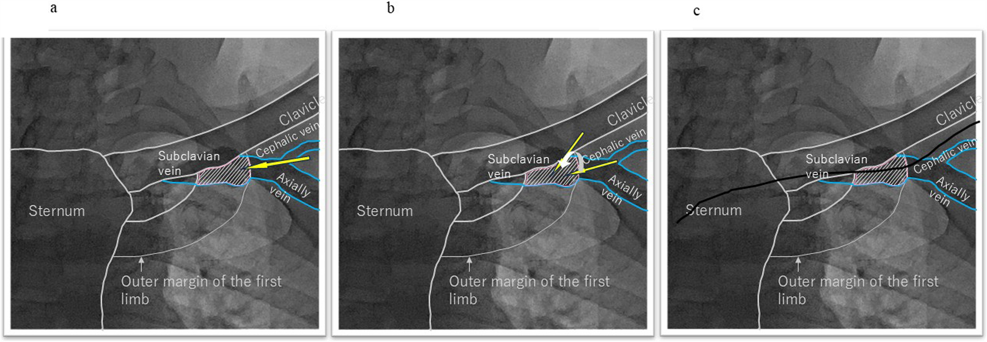 Comparative analysis of ultrasound-guided versus fluoroscopy-guided venous puncture techniques for pacemaker implantation