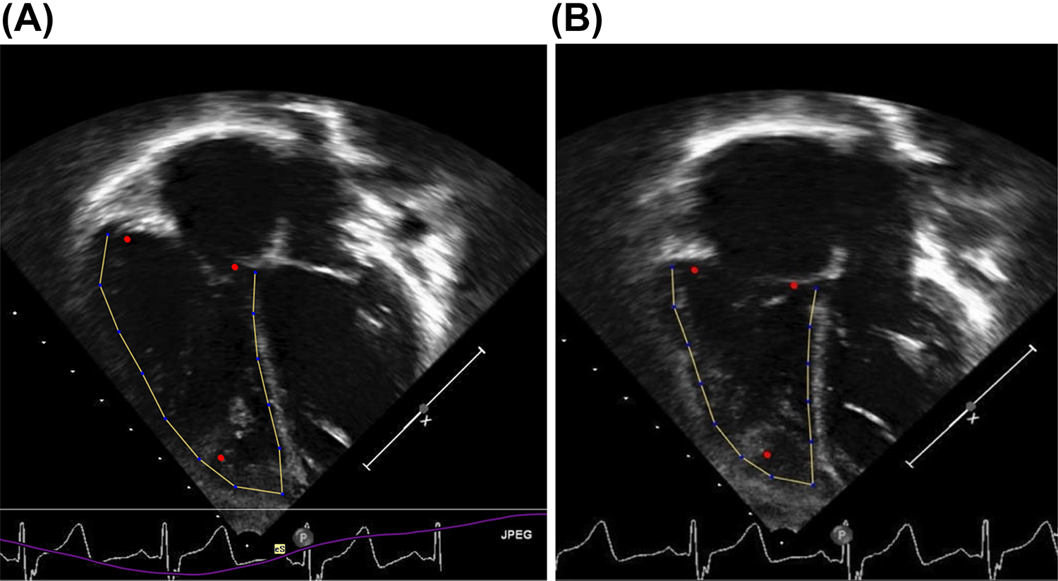 Association of preoperative Circulating biomarkers with echocardiographic measures of right ventricular strain five years after tetralogy of fallot repair