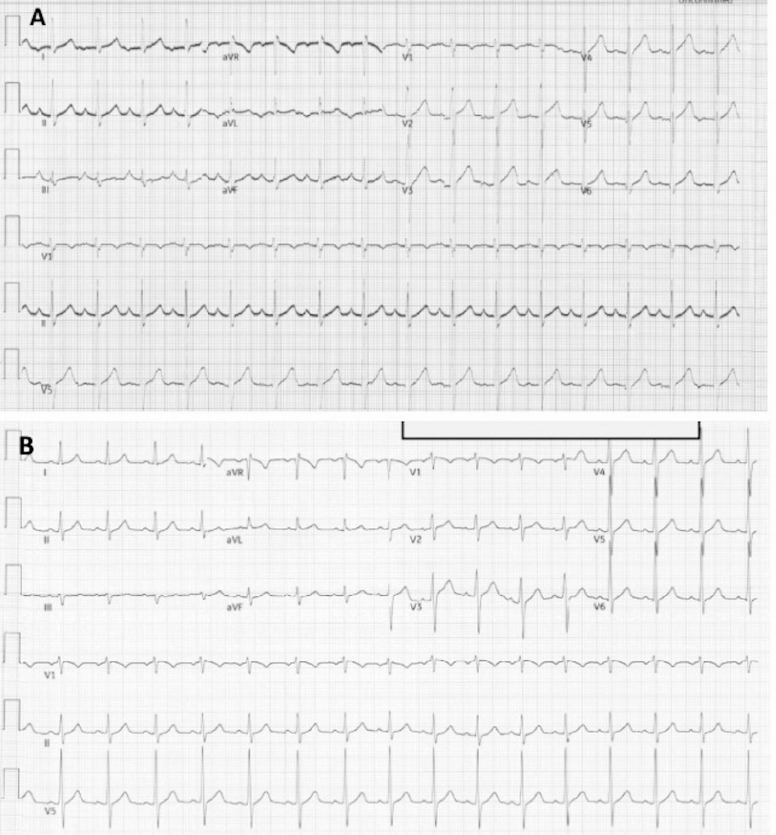 Percutaneous left atrial appendage occlusion following failed surgical ligation for incessant left atrial appendage tachycardia: key role of multimodality imaging