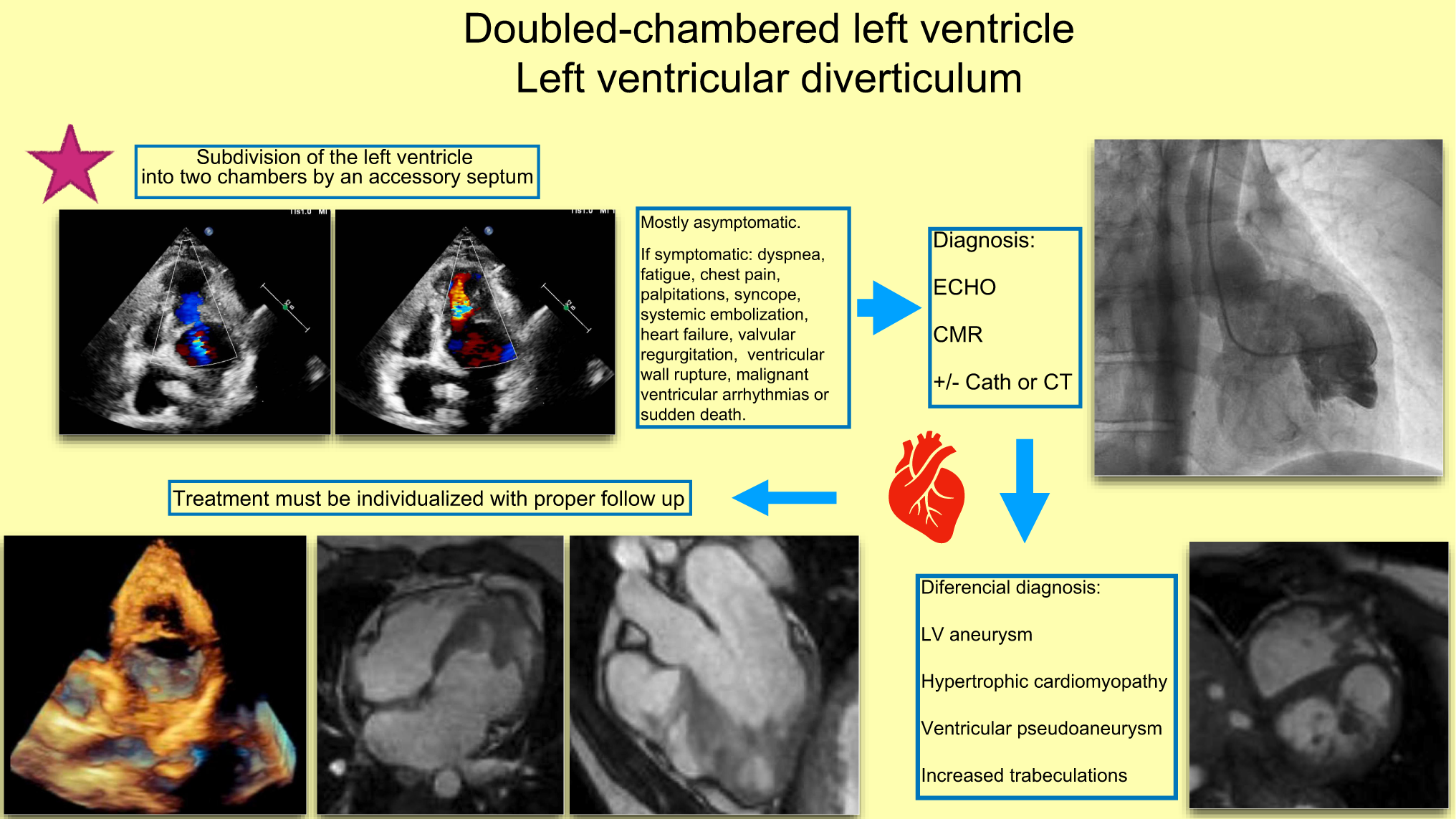 Double chambered left ventricle: an incidental rare congenital heart disease. Report of a case within the context of a literature review