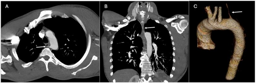 Left aortic arch with aberrant right vertebral artery