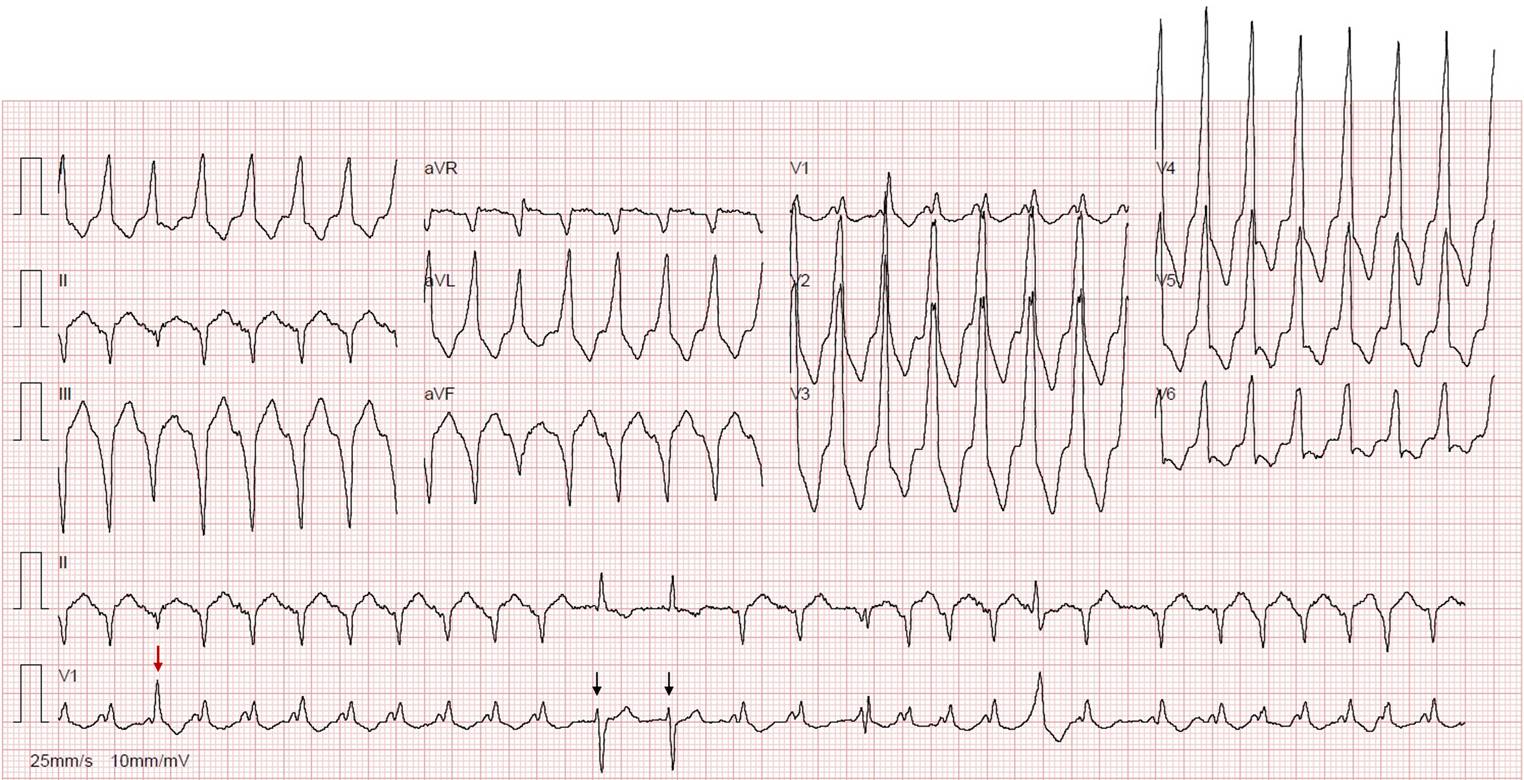 To shock or not to shock?