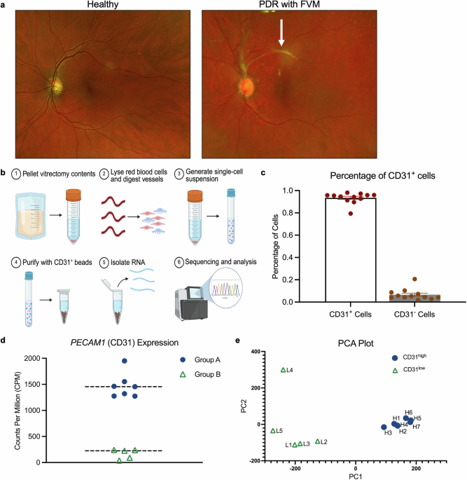 Proliferative diabetic retinopathy subtypes defined by immune defense and endothelial mitochondrial dysfunction