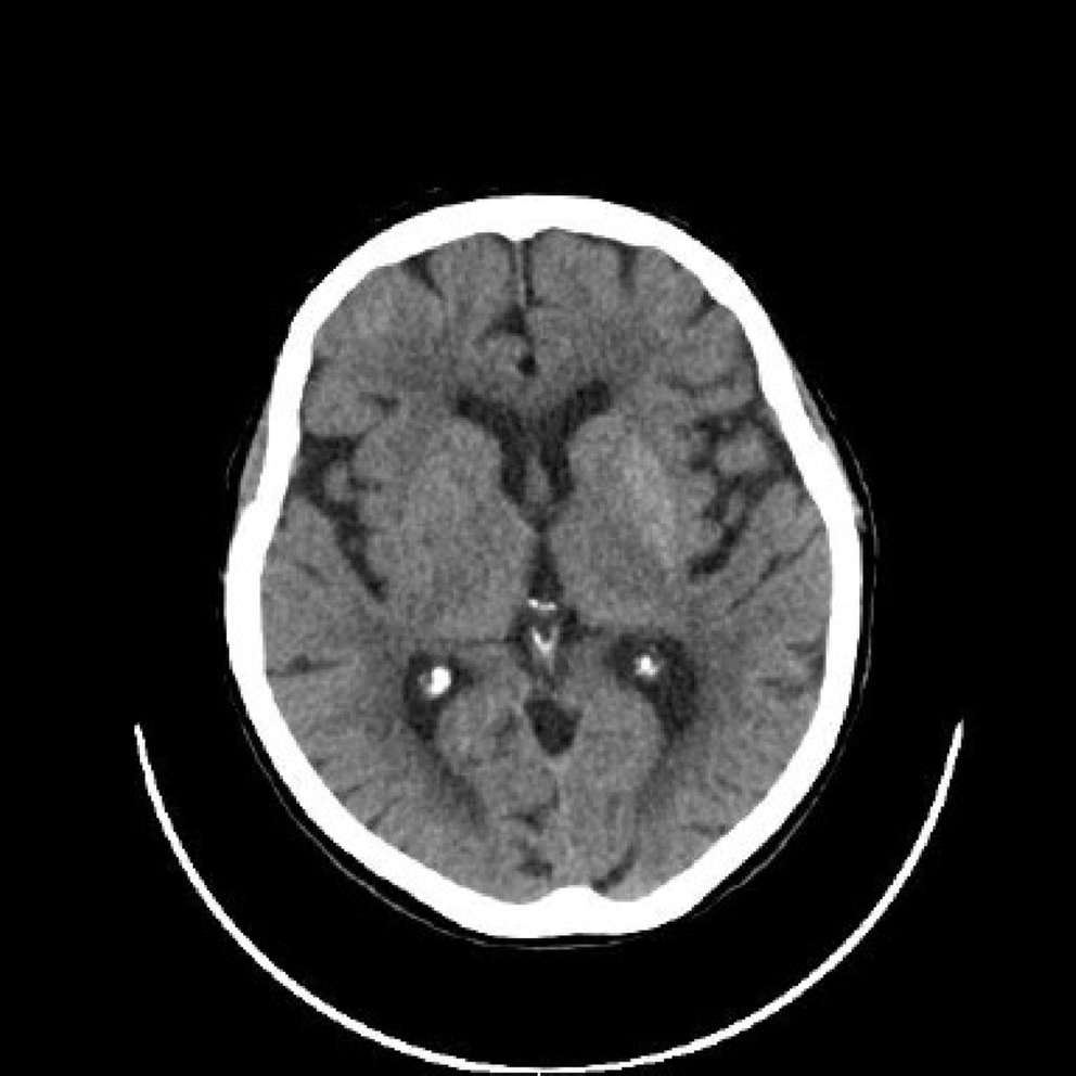 Sudden onset of arm movements in a diabetic patient