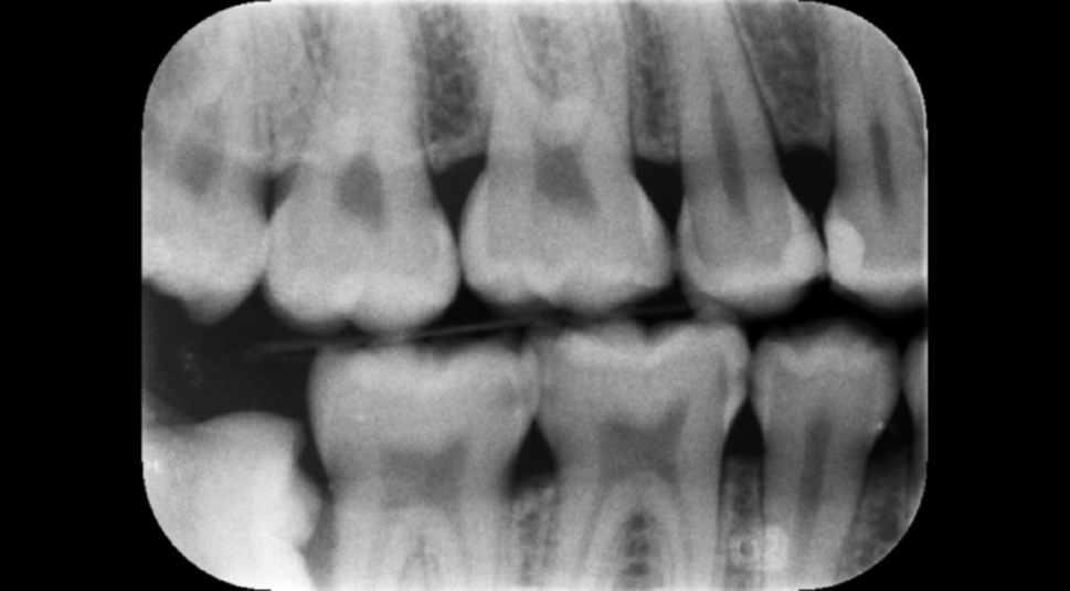 Automated differentiation of caries requiring filling and caries necessitating root canal treatment using machine learning