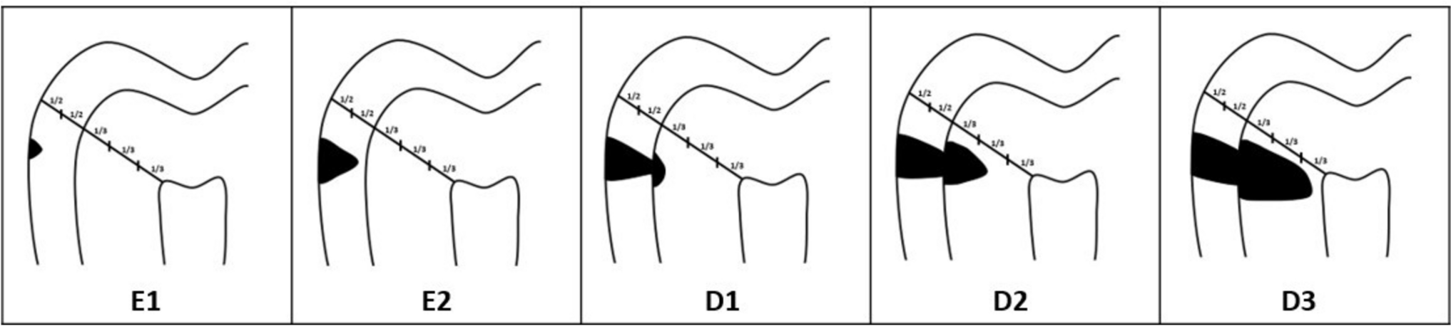 Assessment of posterior interproximal surfaces on bitewing and panoramic radiographs by dental interns and an artificial intelligence application