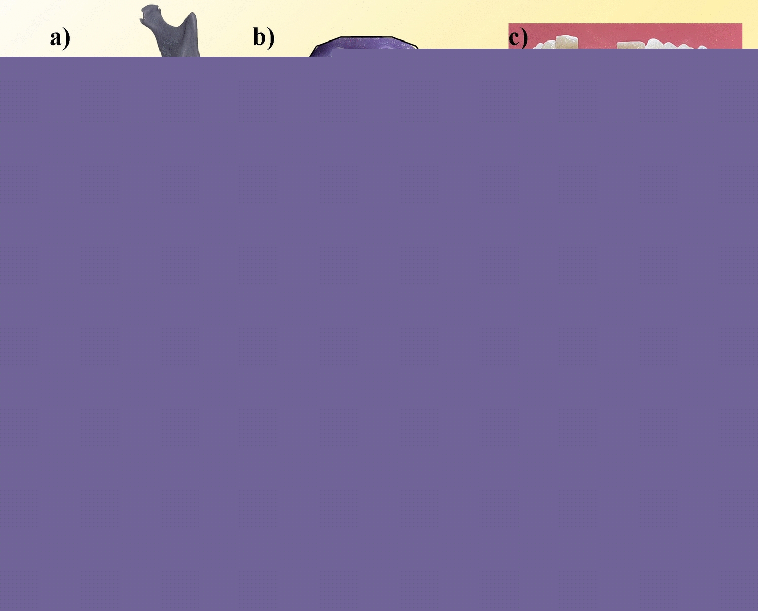 The impact of dental impression materials on metal artifacts in cone beam computed tomography examination