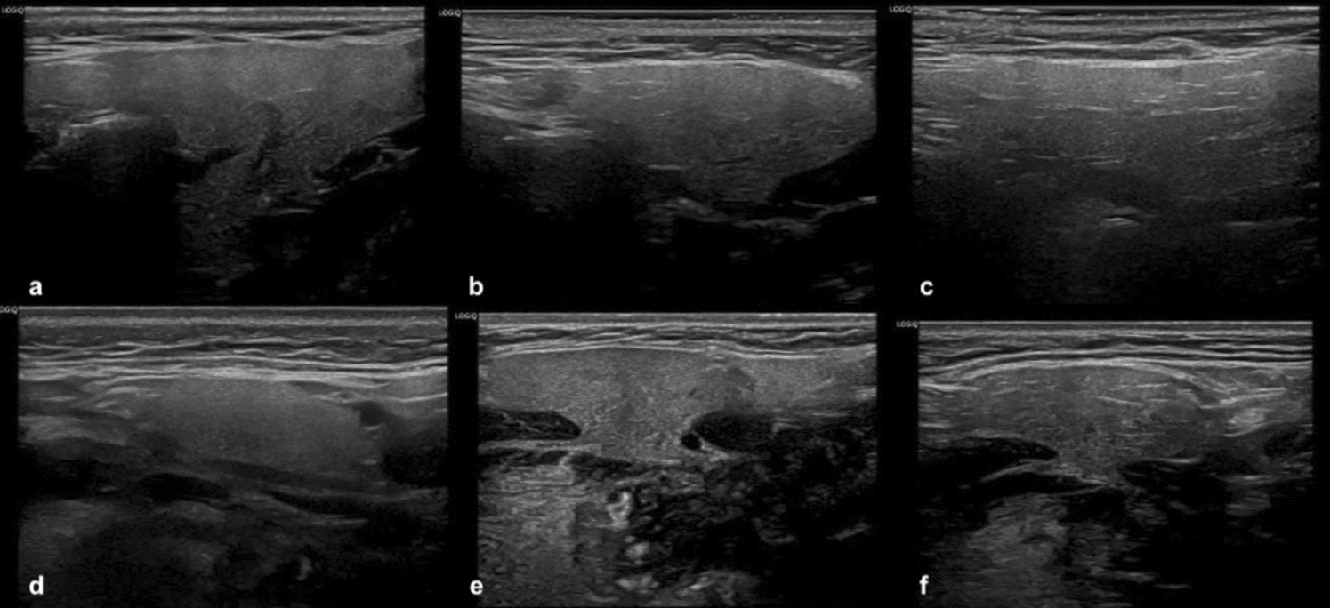 Ultrasonographic evaluation of the parotid and submandibular glands in smokers
