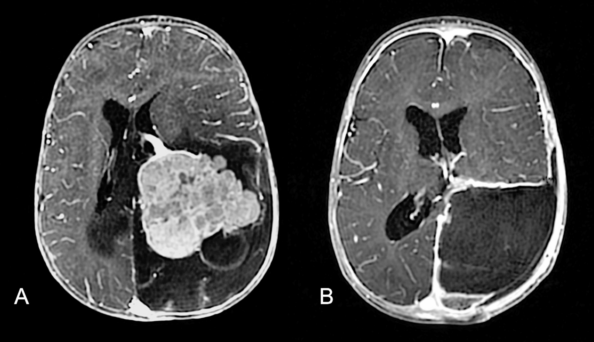 Superselective anterior choroidal artery preoperative embolization of a giant choroid plexus carcinoma in an infant: case report and systematic review