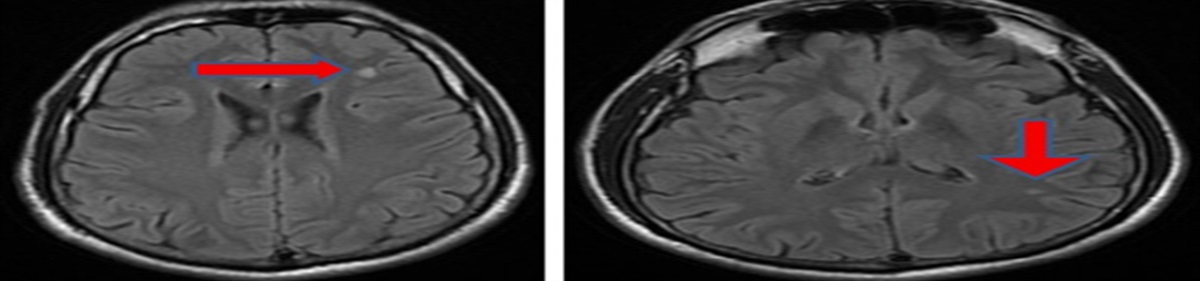 Fabry Disease Frequency Among Young Cryptogenic Stroke Patients in the City of Edirne, Turkey