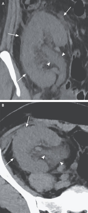 Case 23-2021: A 41-Year-Old Woman with Bloody Stools and Thrombocytopenia