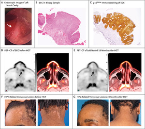 Treatment of Relapsing HPV Diseases by Restored Function of Natural Killer Cells