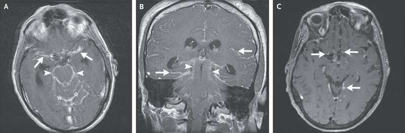 Chronic Meningitis