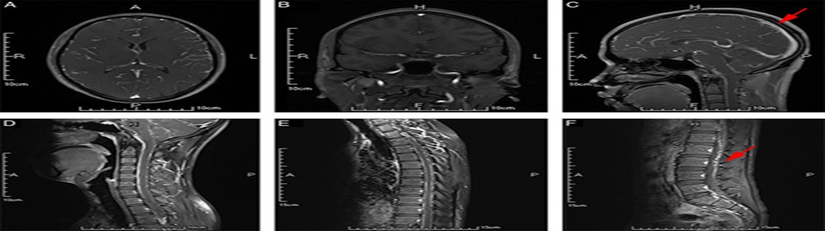 Current Review of Leptomeningeal Amyloidosis Associated With Transthyretin Mutations