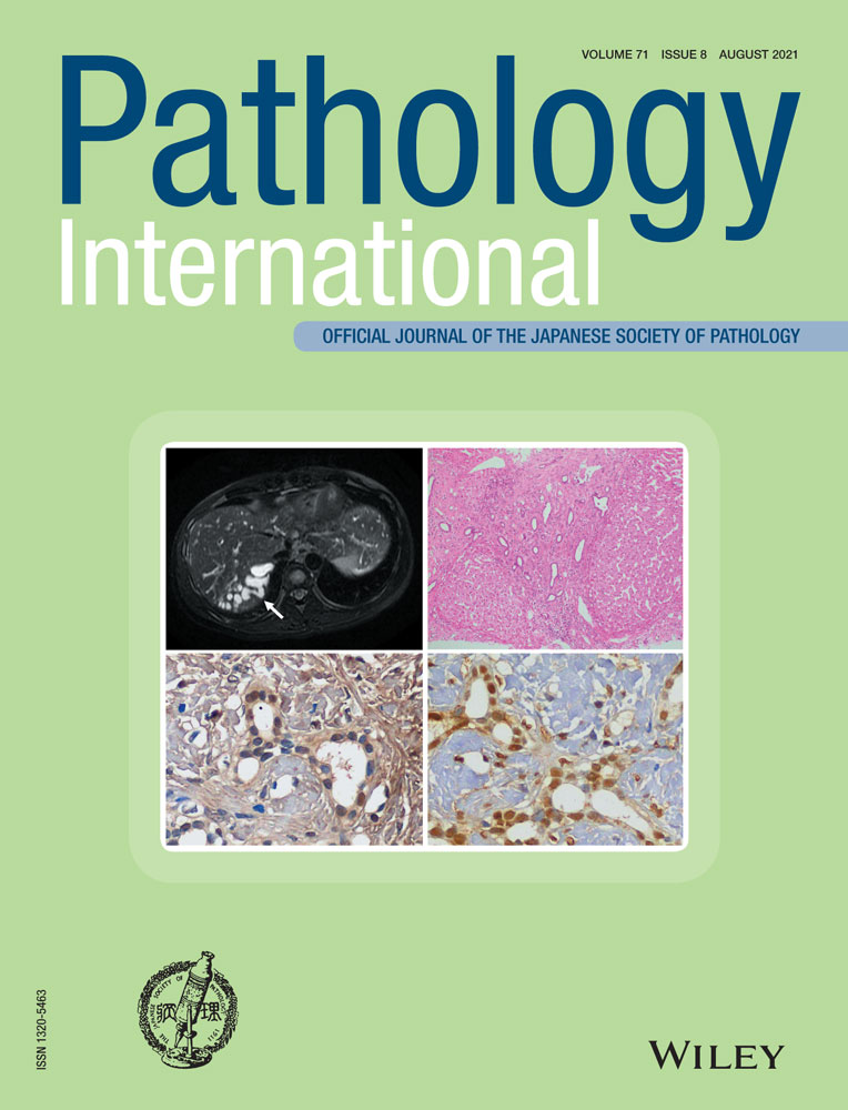 An autopsy case study of lymphocytic hypophysitis induced by nivolumab treatment for esophageal malignant melanoma