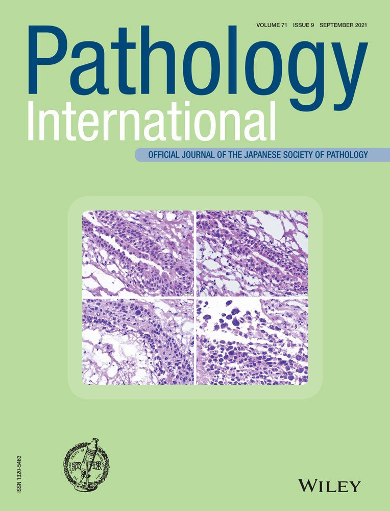 Autopsy case with concurrent transthyretin and immunoglobulin amyloidosis