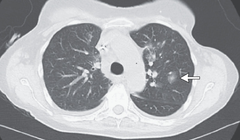 Aspergillus Infections