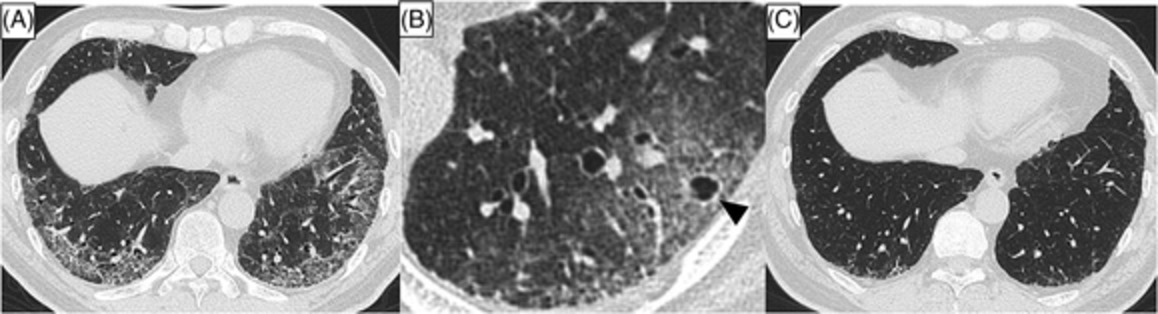 Spontaneous improvement of interstitial pneumonia with autoimmune features: A case report