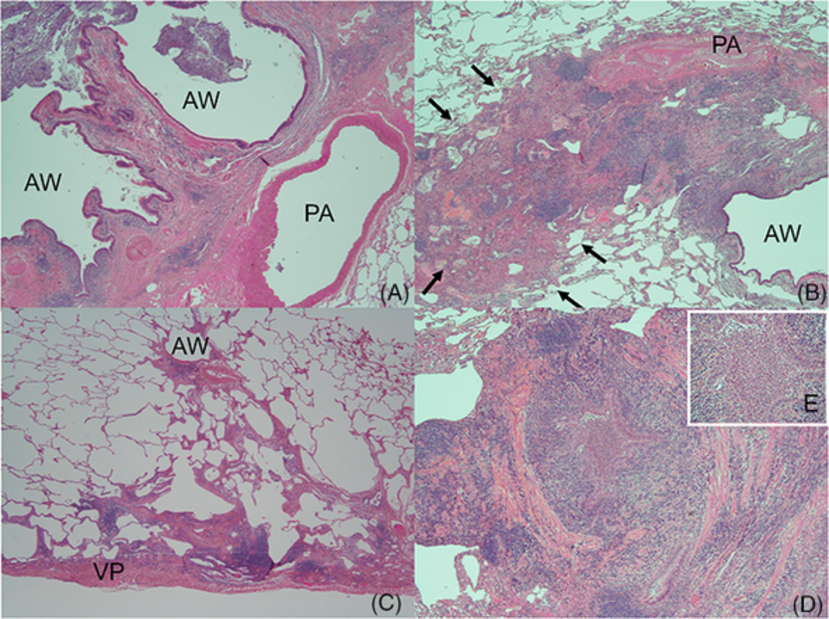 ANOTHER syndrome—Familial presentations of progressive lung disease leading to double lung transplantation: A case report and literature review