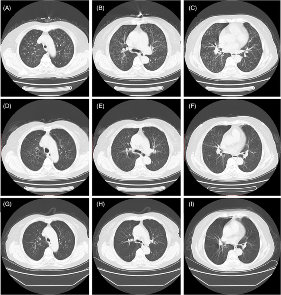 Good's syndrome with diffuse panbronchiolitis as the prominent manifestation: A case and literature review