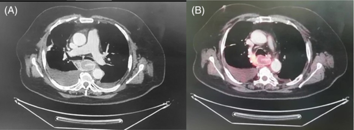 Oesophageal intramural pseudodiverticulosis presenting as non‐resolving pneumonia: A sinister cause diagnosed by EUS‐B‐FNA