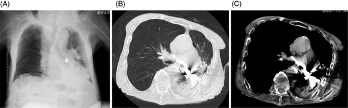 Removal of an aspirated tooth from the bronchus using a cryoprobe: A case report