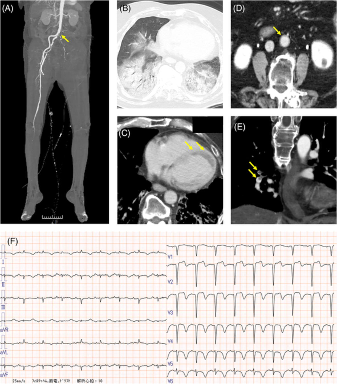 COVID‐19‐induced adult multisystem inflammatory syndrome and fatal acute limb ischaemia