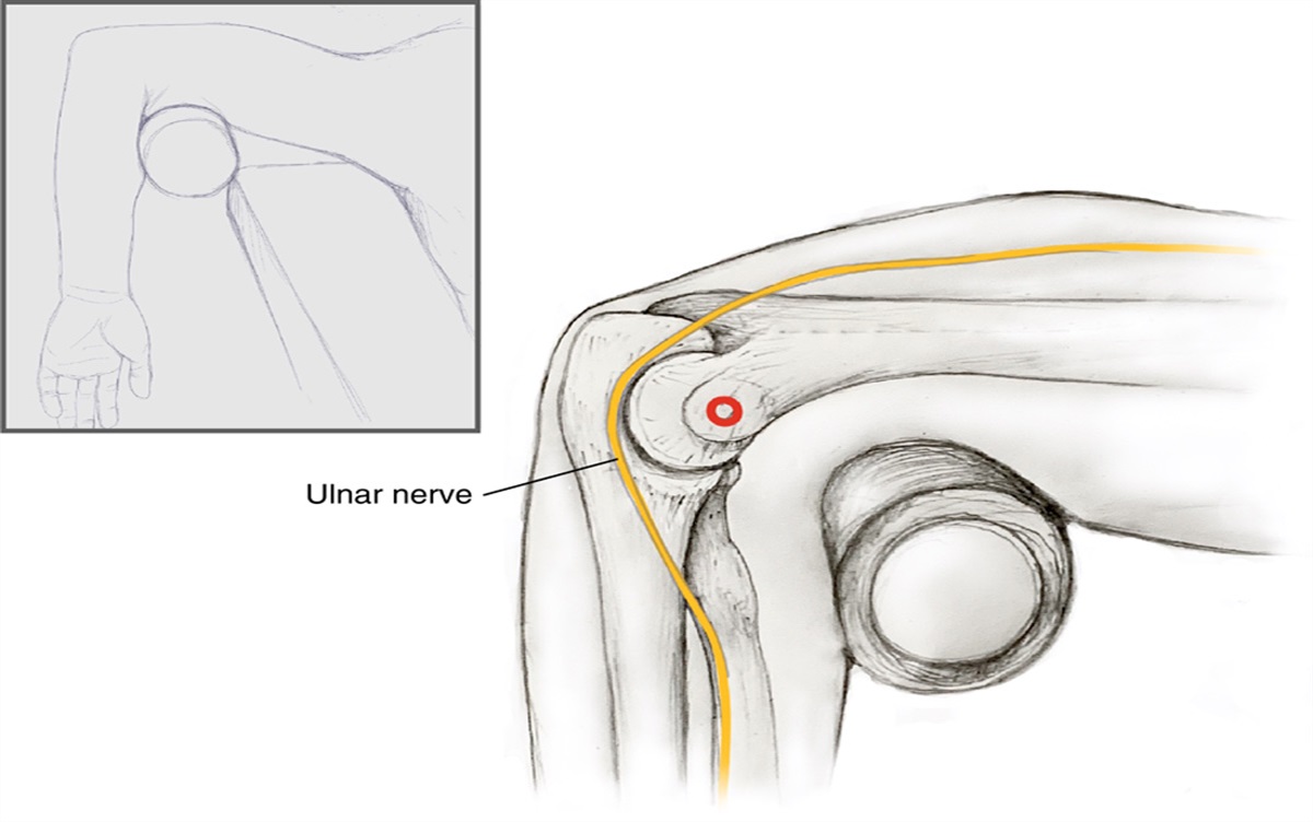 Management of Supracondylar Fractures in the Prone Position: Case Series, Technique, and Literature Review