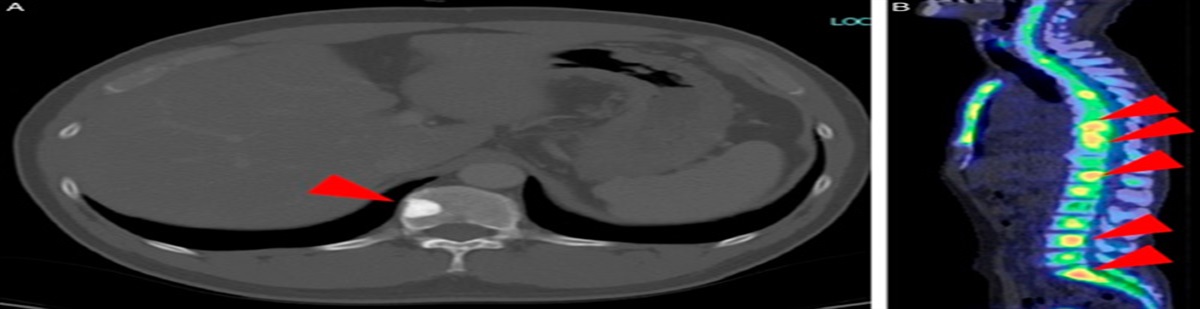 Favorable response to combined androgen blockade for metastatic cutaneous apocrine carcinoma: a case report