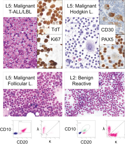 Real‐world experience with the Sydney System on 1458 cases of lymph node fine needle aspiration cytology
