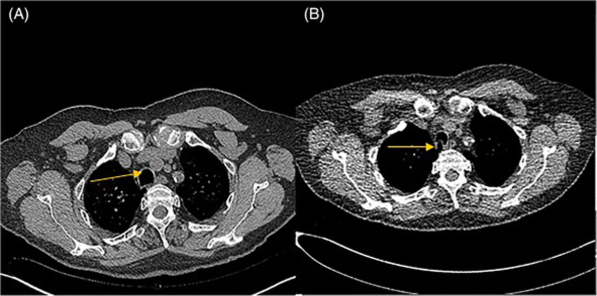 Cinematic CT as a valuable protocol for severe ECAC