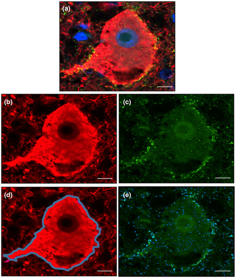 The influence of HLA‐DRB1*15 on the relationship between microglia and neurons in multiple sclerosis normal appearing cortical grey matter