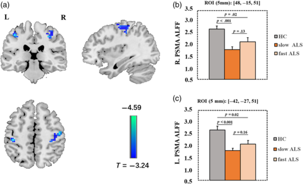 Different sensorimotor mechanism in fast and slow progression amyotrophic lateral sclerosis
