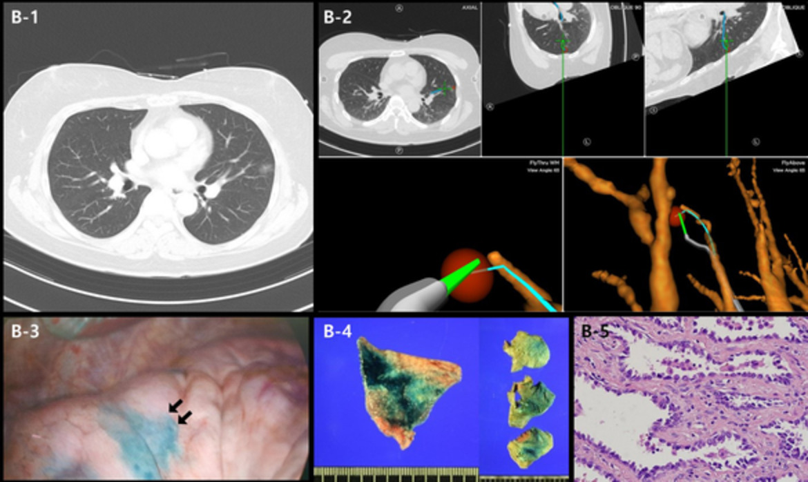 Preoperative electromagnetic navigation bronchoscopy‐guided one‐stage multiple‐dye localization for resection of subsolid nodules: A single‐center pilot study