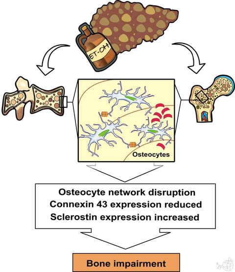 The altered osteocytic expression of connexin 43 and sclerostin in human cadaveric donors with alcoholic liver cirrhosis: Potential treatment targets