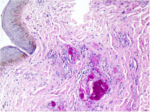 An eye‐opening case of periorbital oedema: a clinicodiagnostic dilemma