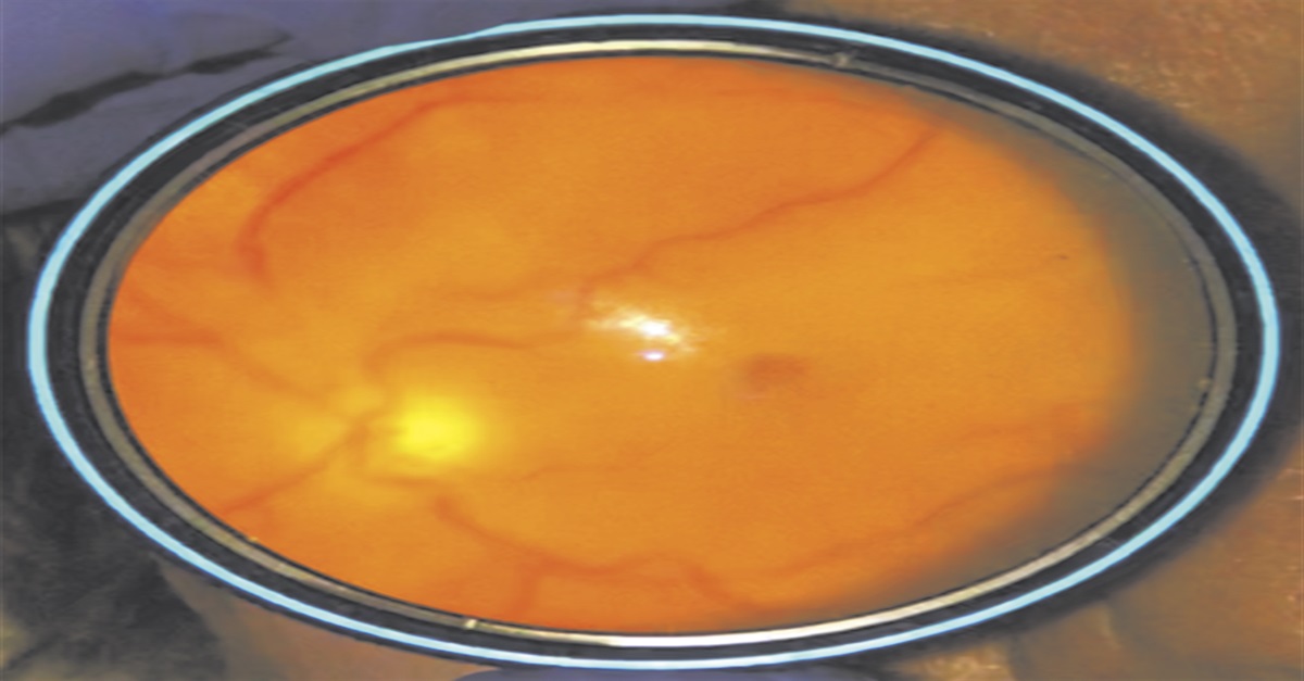 Embolic Abducens Palsy and Central Retinal Artery Occlusion in a Patient With COVID-19