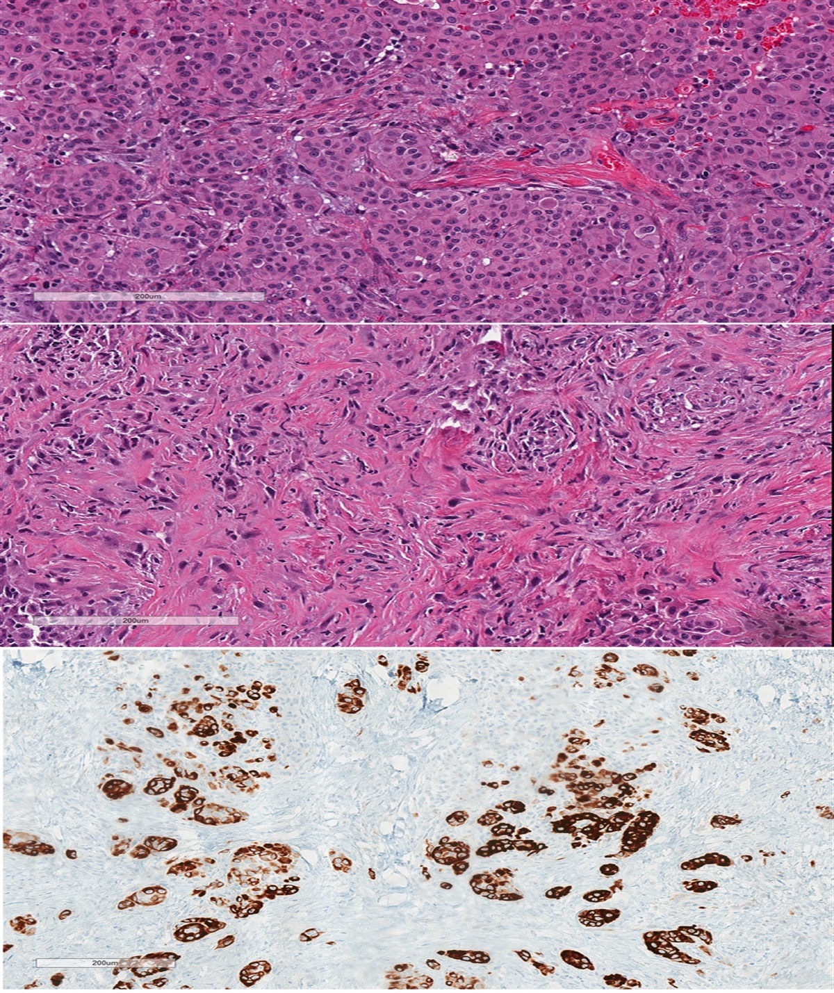 Nivolumab-Induced Peritonitis With Mesothelial Hyperplasia Mimicking Metastatic Mesothelioma