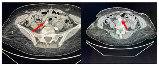 Cardiogenetics, Vol. 12, Pages 212-217: Identification of Single-Nucleotide Polymorphisms in ZNF469 in a Patient with Aortoiliac Aneurysmal Disease