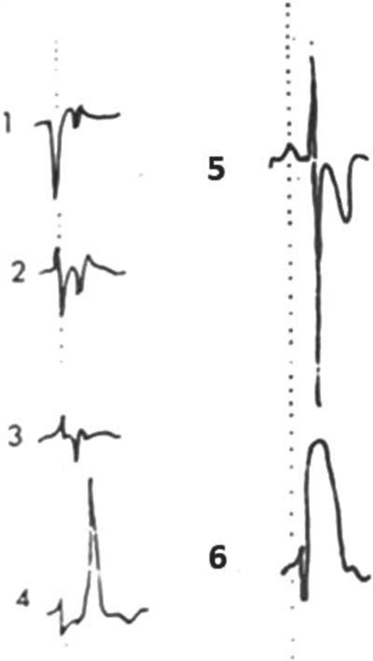 Study of Bradyarrhythmias in Acute Myocardial Infarction